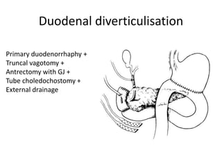 Duodenal diverticulisation
Primary duodenorrhaphy +
Truncal vagotomy +
Antrectomy with GJ +
Tube choledochostomy +
External drainage
 