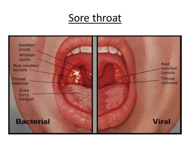 Inflammation In Throat 44