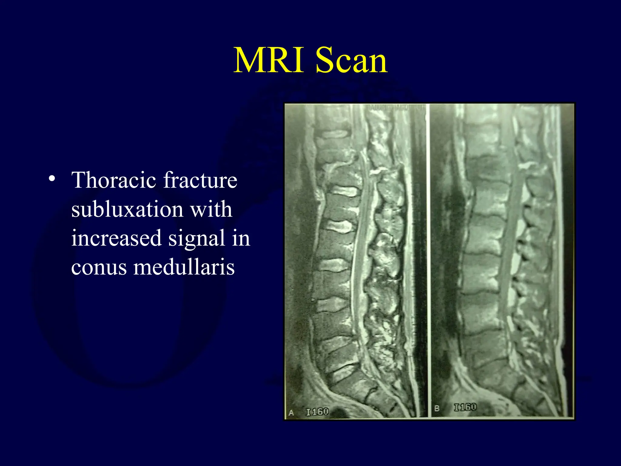 MRI Scan
• Thoracic fracture
subluxation with
increased signal in
conus medullaris
 