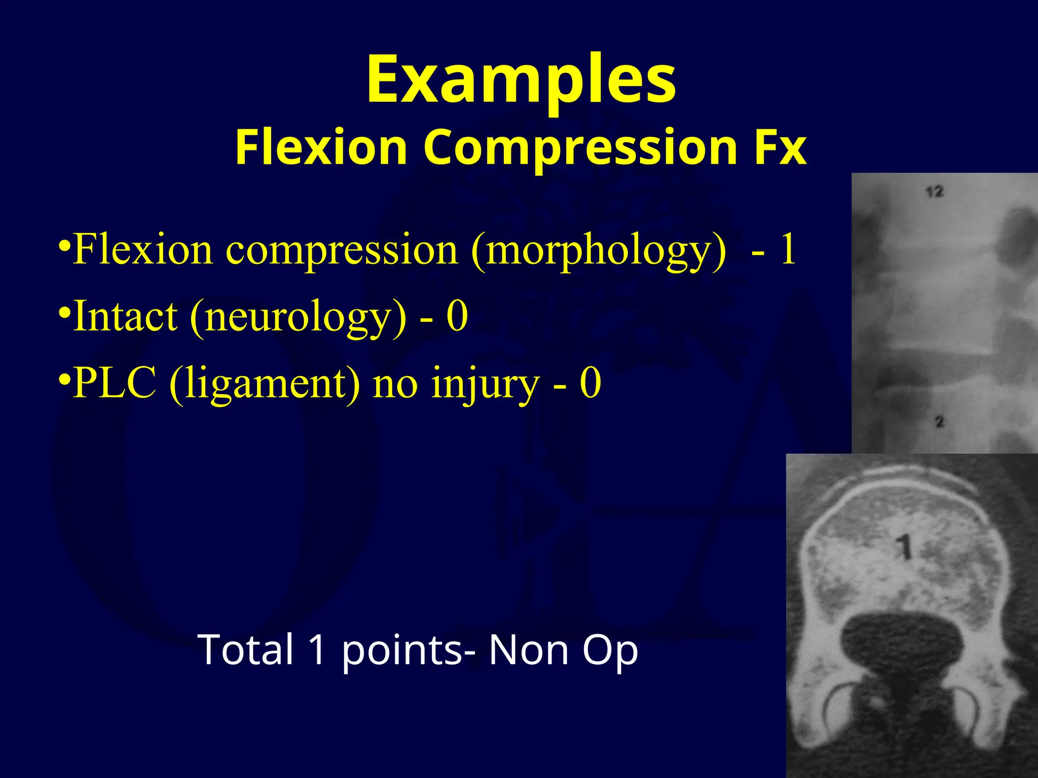 Examples
Flexion Compression Fx
•Flexion compression (morphology) - 1
•Intact (neurology) - 0
•PLC (ligament) no injury - 0
Total 1 points- Non Op
 