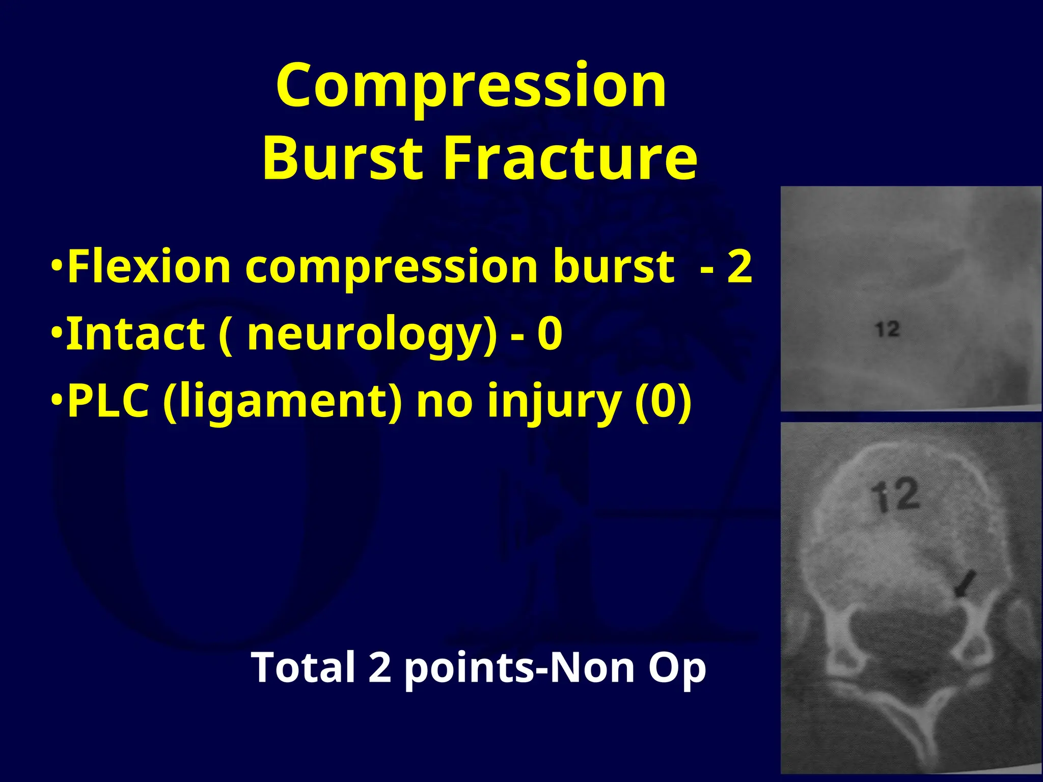 Compression
Burst Fracture
•Flexion compression burst - 2
•Intact ( neurology) - 0
•PLC (ligament) no injury (0)
Total 2 points-Non Op
 