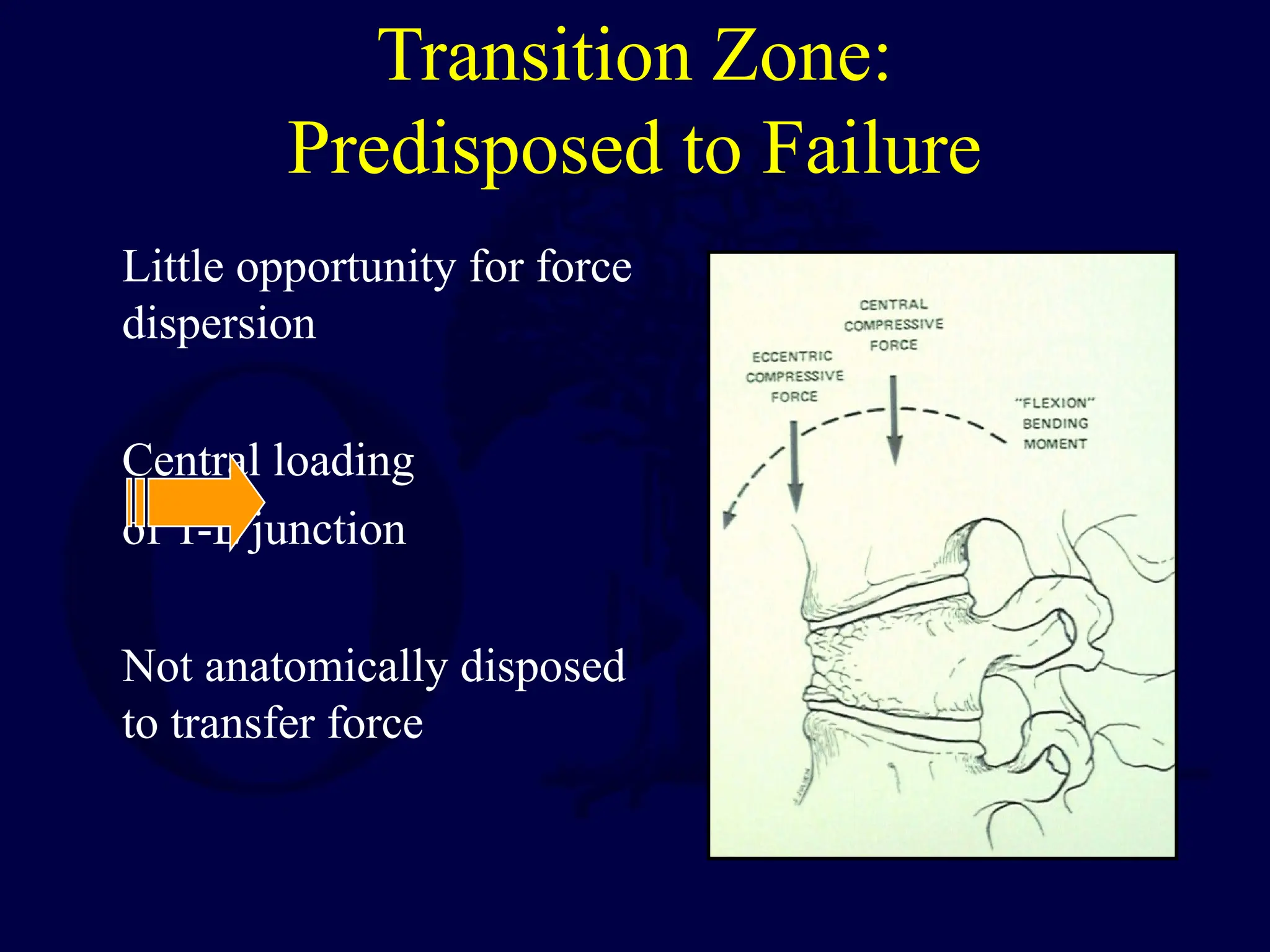Transition Zone:
Predisposed to Failure
Little opportunity for force
dispersion
Central loading
of T-L junction
Not anatomically disposed
to transfer force
 