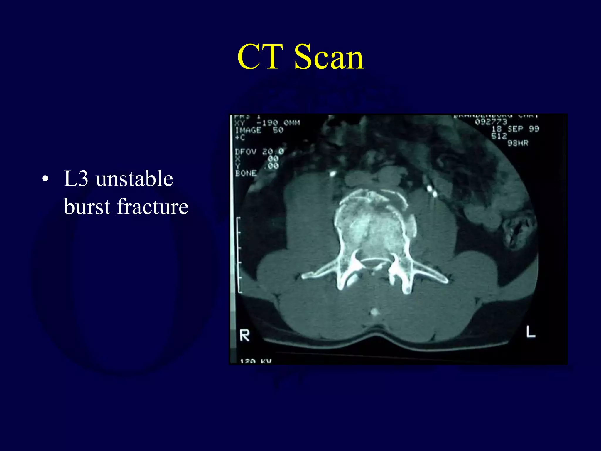 CT Scan
• L3 unstable
burst fracture
 