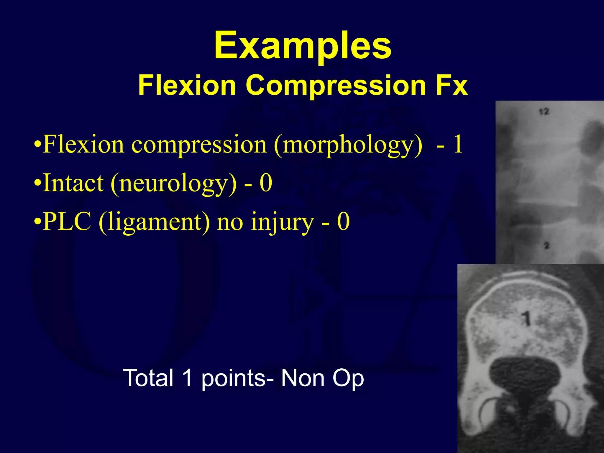 Examples
Flexion Compression Fx
•Flexion compression (morphology) - 1
•Intact (neurology) - 0
•PLC (ligament) no injury - 0
Total 1 points- Non Op
 