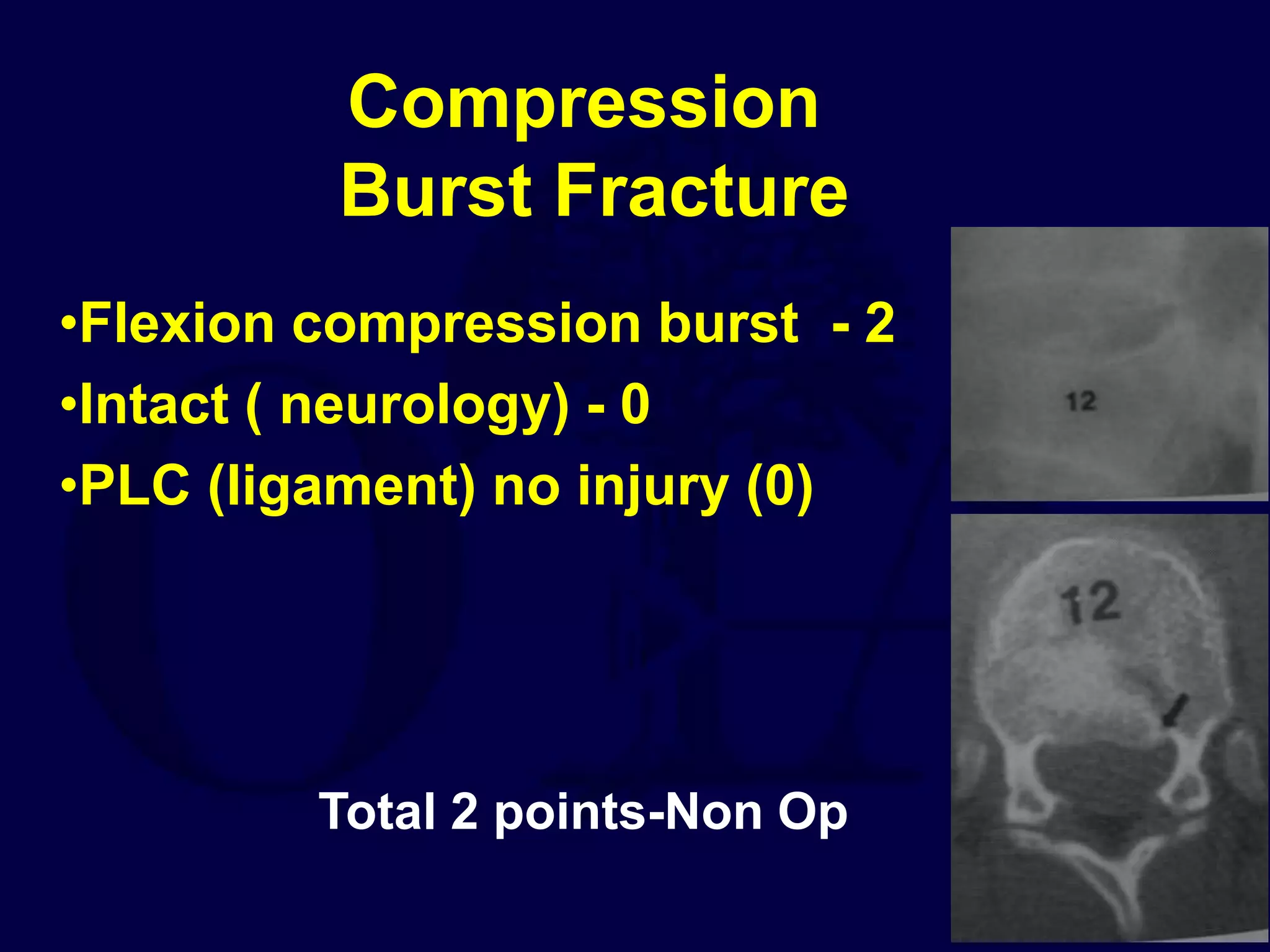 Compression
Burst Fracture
•Flexion compression burst - 2
•Intact ( neurology) - 0
•PLC (ligament) no injury (0)
Total 2 points-Non Op
 