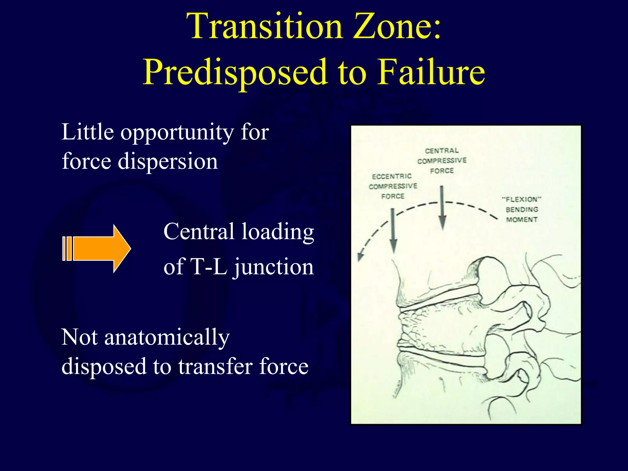 Transition Zone:
Predisposed to Failure
Little opportunity for
force dispersion
Central loading
of T-L junction
Not anatomically
disposed to transfer force
 