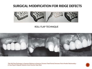 Flaring Ridge Defect Comprehensive Esthetic Principles in Fixed Partial Dentures for Optimal ...
