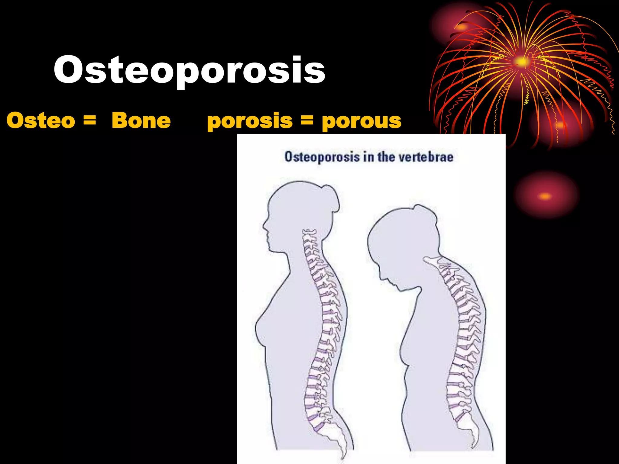 Osteoporosis
Osteo = Bone porosis = porous
 