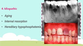 Physical
 Thermal :
. Large metallic restorations without base .
. cavity preparation .
. setting of some cements e.g. Ac...