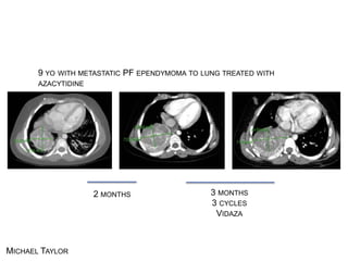 2 MONTHS 3 MONTHS
3 CYCLES VIDAZA
9 YO WITH METASTATIC PF EPENDYMOMA TO LUNG TREATED WITH AZACYTIDINE
TREATMENT OF METASTATIC PF EPENDYMOMA WITH VIDAZA
MICHAEL TAYLOR
 