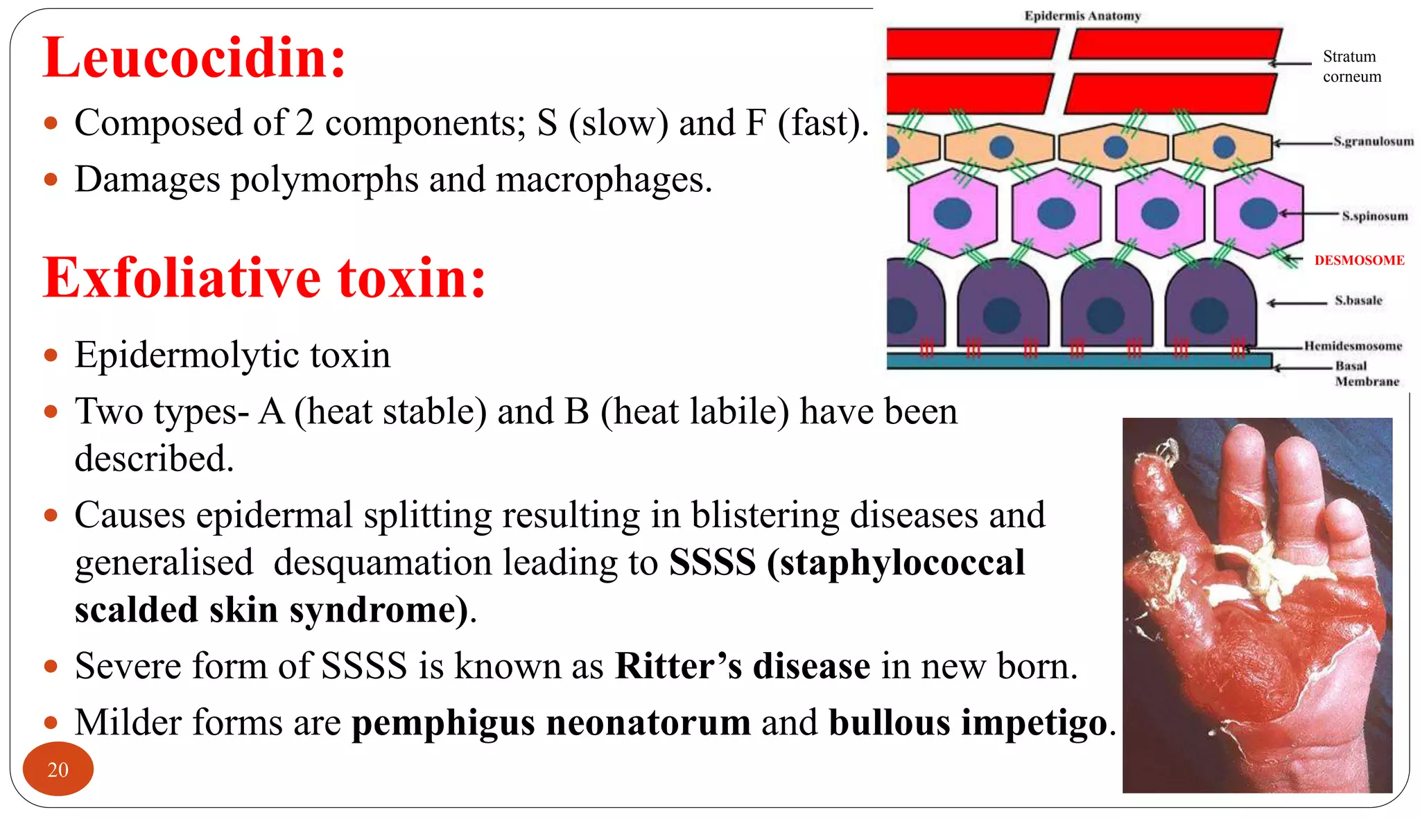 Leucocidin:
20
 Composed of 2 components; S (slow) and F (fast).
 Damages polymorphs and macrophages.
Exfoliative toxin:
 Epidermolytic toxin
 Two types- A (heat stable) and B (heat labile) have been
described.
 Causes epidermal splitting resulting in blistering diseases and
generalised desquamation leading to SSSS (staphylococcal
scalded skin syndrome).
 Severe form of SSSS is known as Ritter’s disease in new born.
 Milder forms are pemphigus neonatorum and bullous impetigo.
Stratum
corneum
DESMOSOME
 