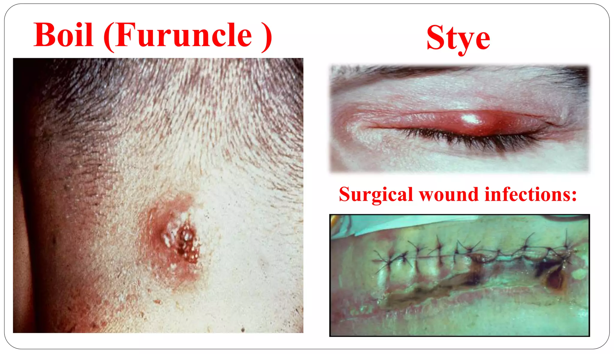 Boil (Furuncle )
26
Stye
Surgical wound infections:
 