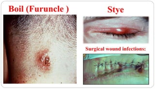 Boil (Furuncle )
26
Stye
Surgical wound infections:
 