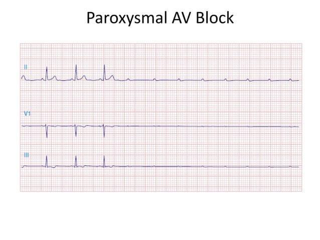 Bradyarrhythmias And Av Block _ Bradyarrhythmias: Clinical significance ...