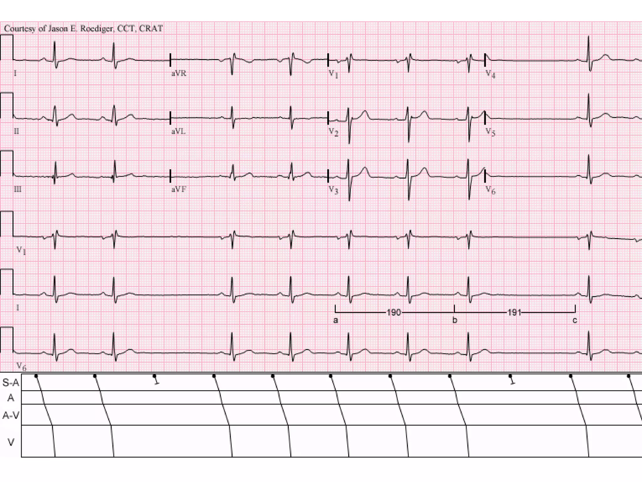 ECG Lecture: Sinus arrest, sinoatrial exit block, AV block and escape ...