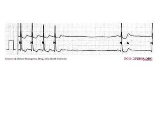 ECG Lecture: Sinus arrest, sinoatrial exit block, AV block and escape ...