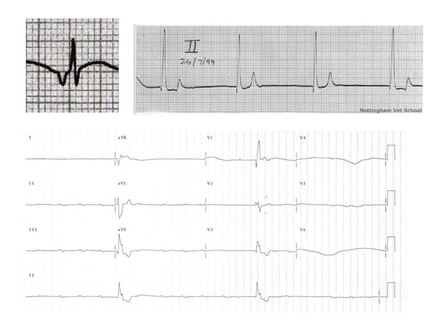 ECG Lecture: Sinus arrest, sinoatrial exit block, AV block and escape ...