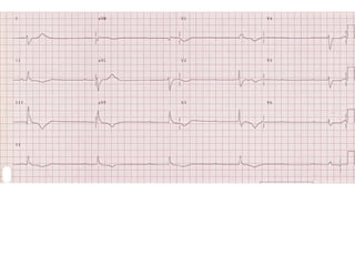 ECG Lecture: Sinus arrest, sinoatrial exit block, AV block and escape ...