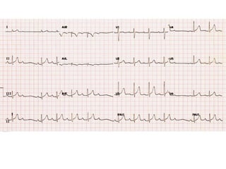 ECG Lecture: Sinus arrest, sinoatrial exit block, AV block and escape ...