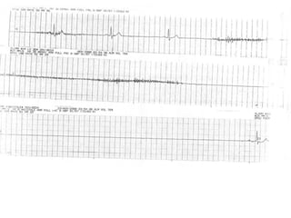 ECG Lecture: Sinus arrest, sinoatrial exit block, AV block and escape ...