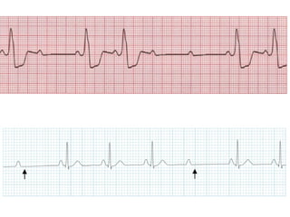 ECG Lecture: Sinus arrest, sinoatrial exit block, AV block and escape ...