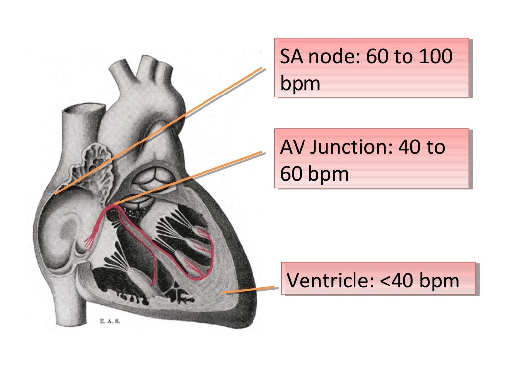 ECG Lecture Sinus arrest, sinoatrial exit block, AV block and escape…