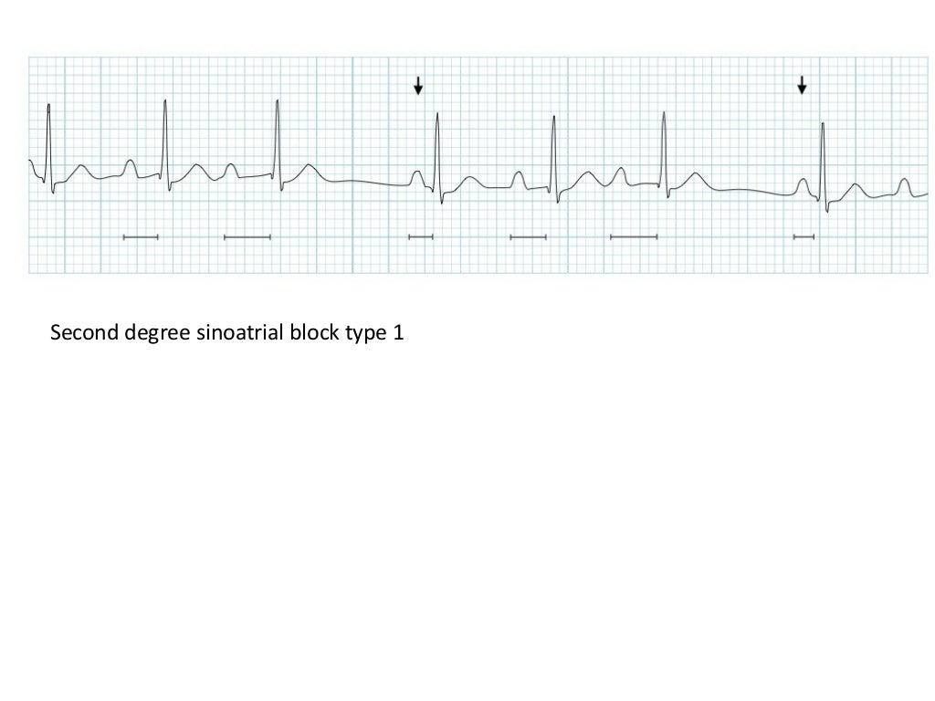 ECG Lecture Sinus arrest, sinoatrial exit block, AV block and escape…