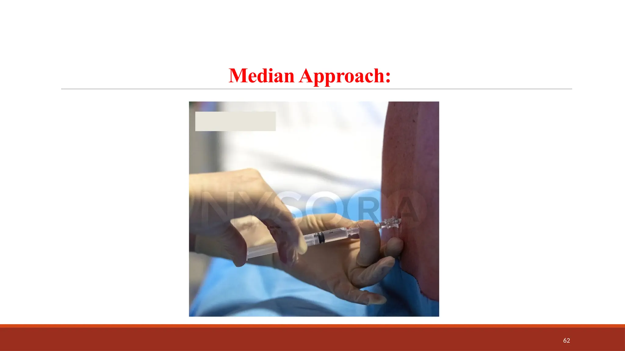 62
Median Approach:
 