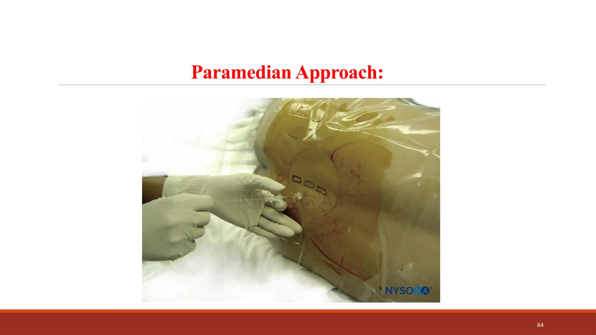 64
Paramedian Approach:
 
