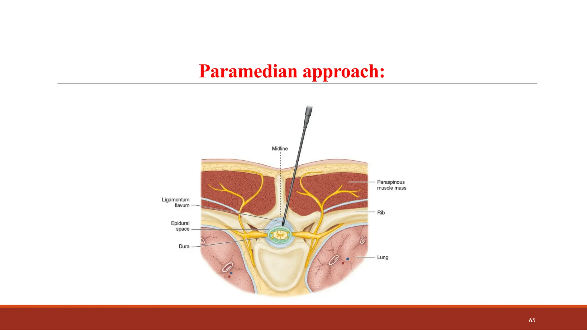 65
Paramedian approach:
 