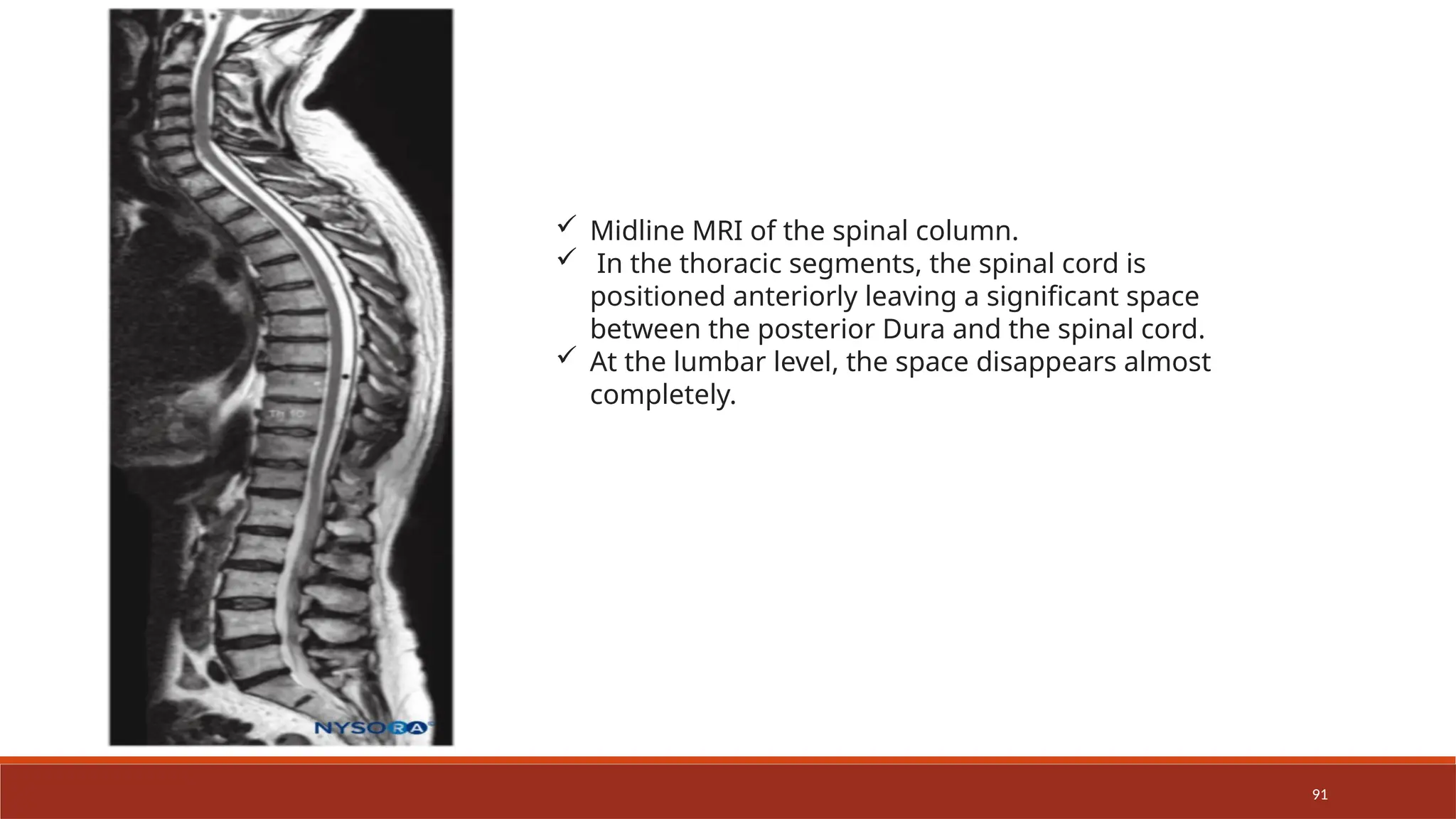 91
 Midline MRI of the spinal column.
 In the thoracic segments, the spinal cord is
positioned anteriorly leaving a significant space
between the posterior Dura and the spinal cord.
 At the lumbar level, the space disappears almost
completely.
 