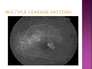 central serous chorioretinopathy | PPTX