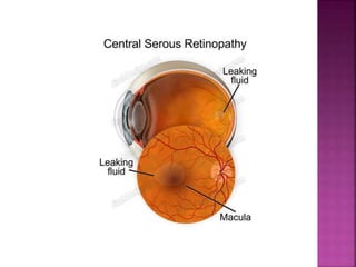 central serous chorioretinopathy | PPTX