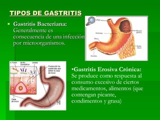 TIPOS DE GASTRITIS Gastritis Bacteriana:  Generalmente es consecuencia de una infección por microorganismos. Gastritis Erosiva Crónica:  Se produce como respuesta al consumo excesivo de ciertos medicamentos, alimentos (que contengan picante, condimentos y grasa) 