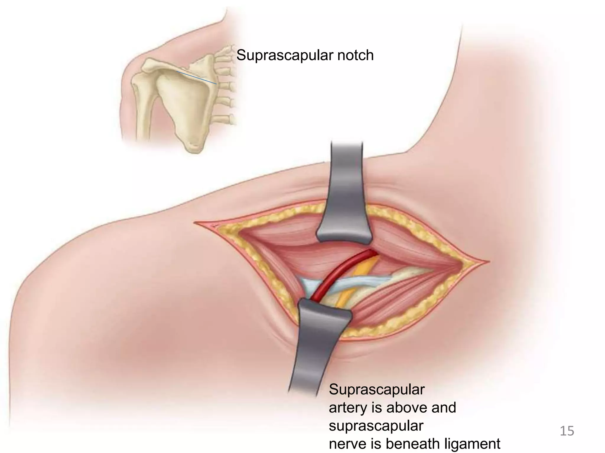 Suprascapular notch
Suprascapular
artery is above and
suprascapular
nerve is beneath ligament
15
 