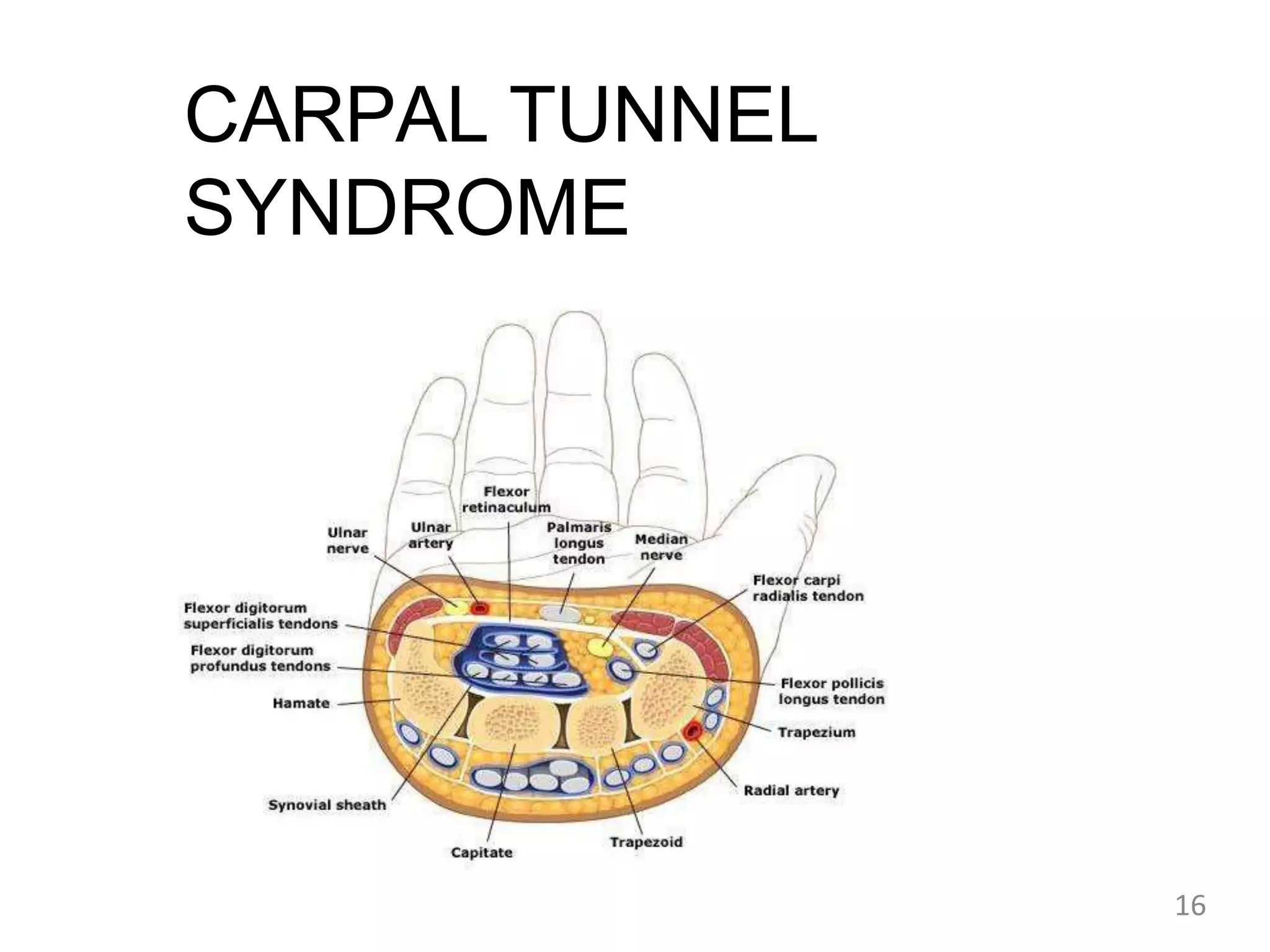 CARPAL TUNNEL
SYNDROME
16
 
