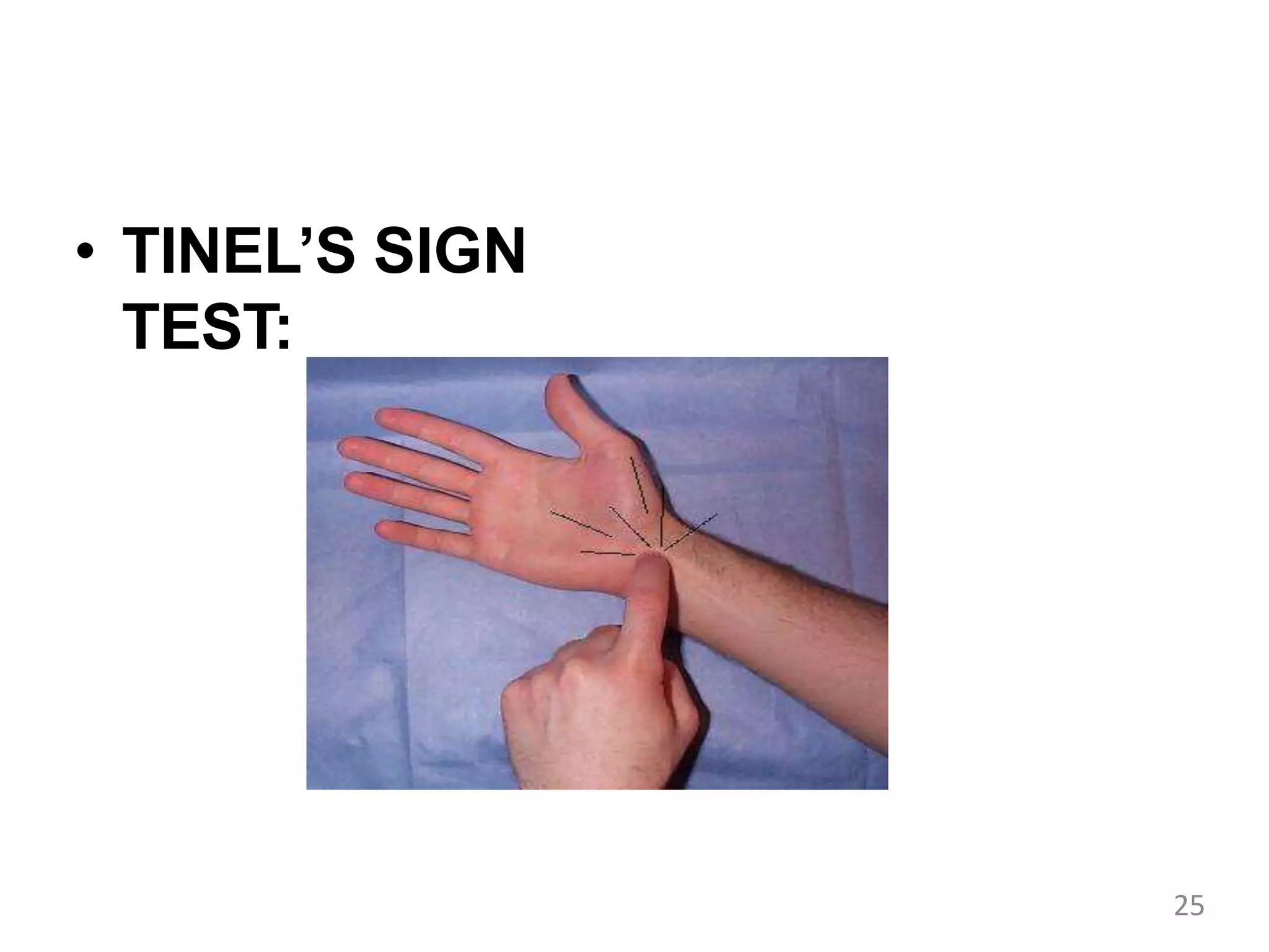• TINEL’S SIGN
TEST:
25
 