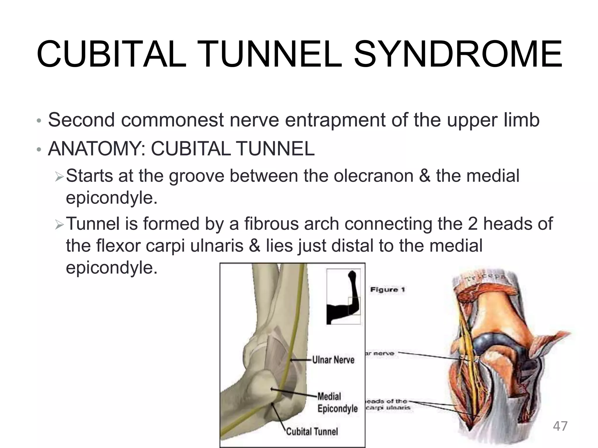 CUBITAL TUNNEL SYNDROME
• Second commonest nerve entrapment of the upper limb
• ANATOMY: CUBITAL TUNNEL
Starts at the groove between the olecranon & the medial
epicondyle.
Tunnel is formed by a fibrous arch connecting the 2 heads of
the flexor carpi ulnaris & lies just distal to the medial
epicondyle.
47
 