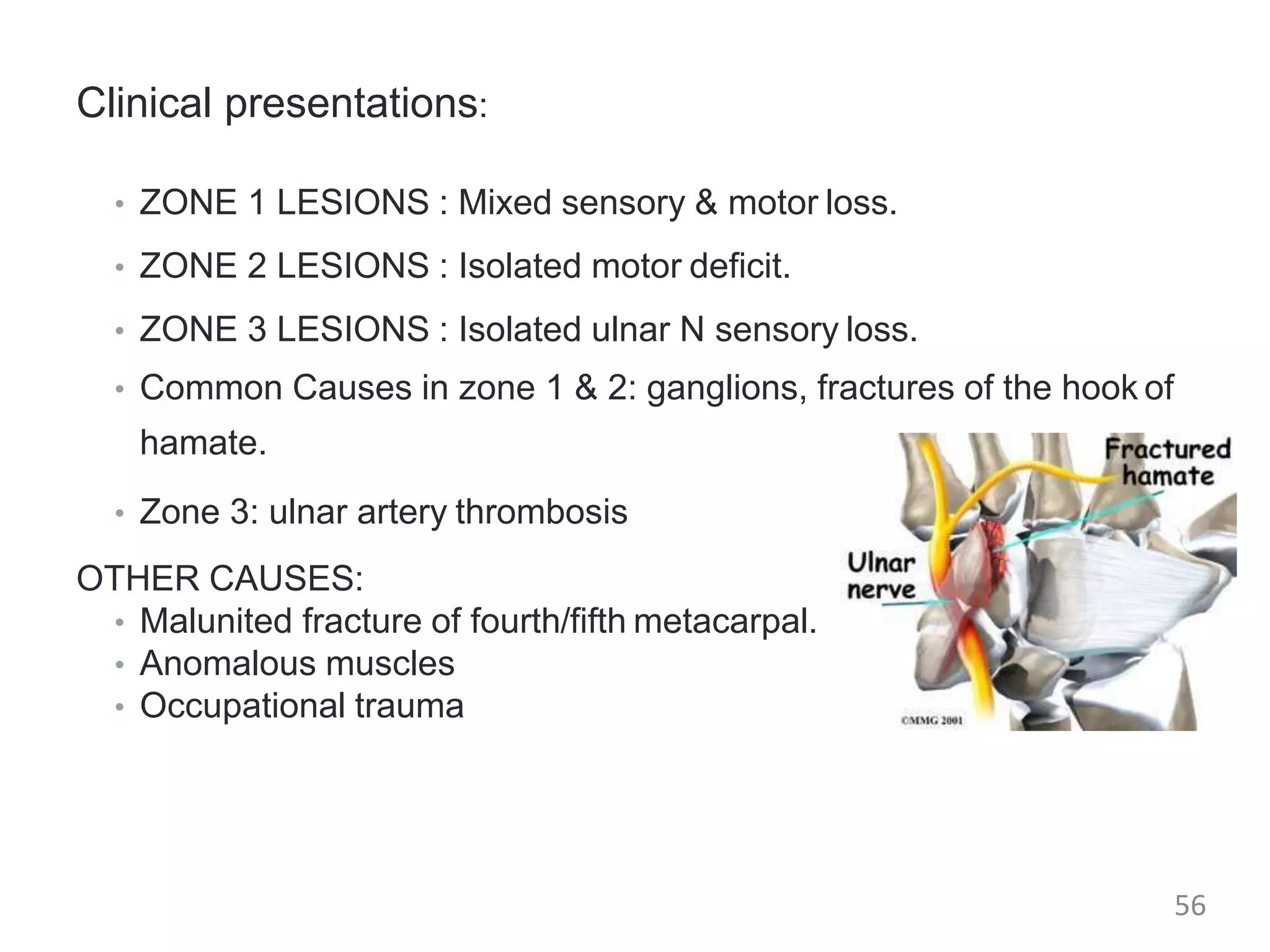 Clinical presentations:
• ZONE 1 LESIONS : Mixed sensory & motor loss.
• ZONE 2 LESIONS : Isolated motor deficit.
• ZONE 3 LESIONS : Isolated ulnar N sensory loss.
• Common Causes in zone 1 & 2: ganglions, fractures of the hook of
hamate.
• Zone 3: ulnar artery thrombosis
OTHER CAUSES:
• Malunited fracture of fourth/fifth metacarpal.
• Anomalous muscles
• Occupational trauma
56
 