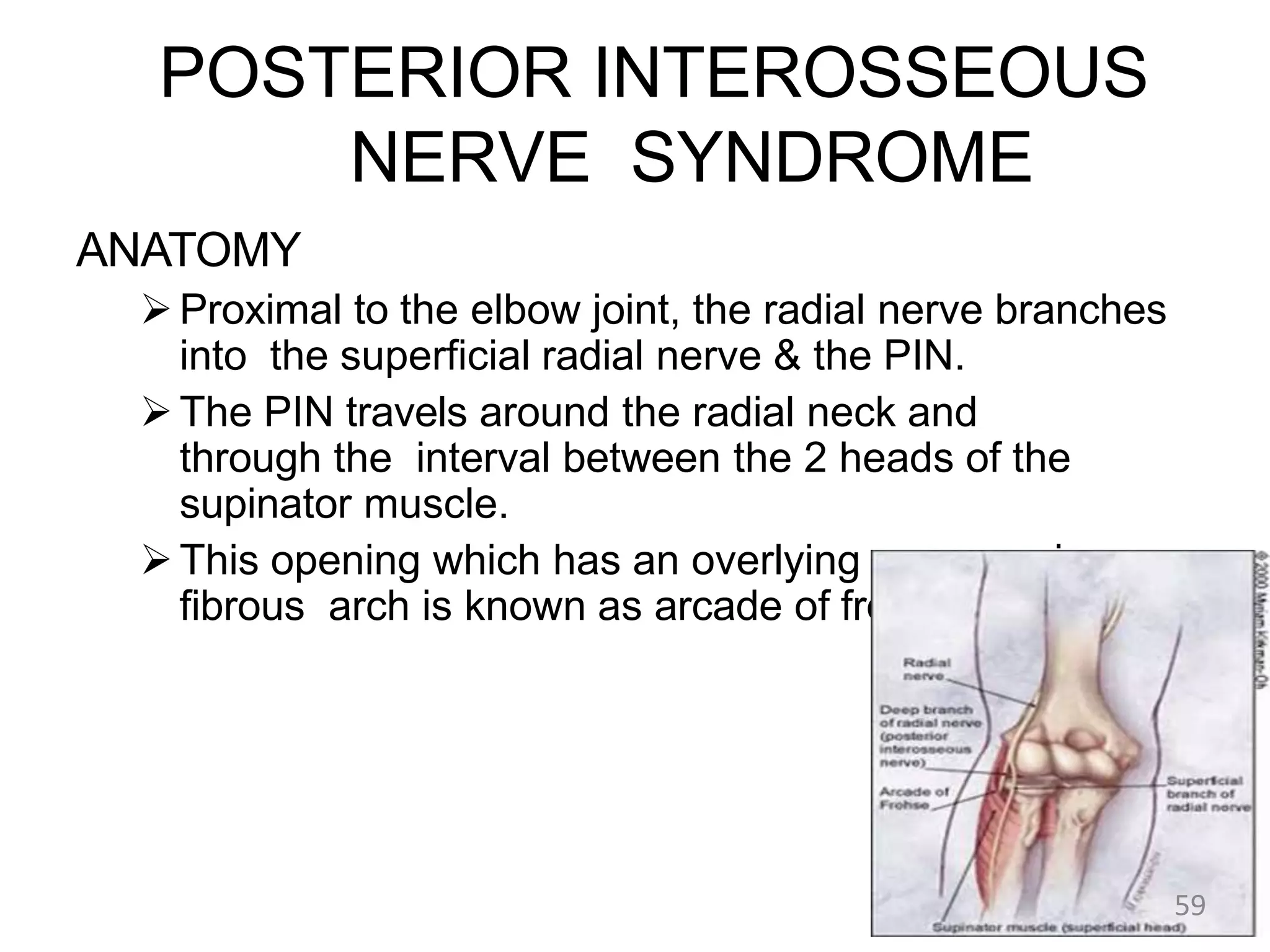 POSTERIOR INTEROSSEOUS
NERVE SYNDROME
ANATOMY
Proximal to the elbow joint, the radial nerve branches
into the superficial radial nerve & the PIN.
The PIN travels around the radial neck and
through the interval between the 2 heads of the
supinator muscle.
This opening which has an overlying compressive
fibrous arch is known as arcade of frosche.
59
 