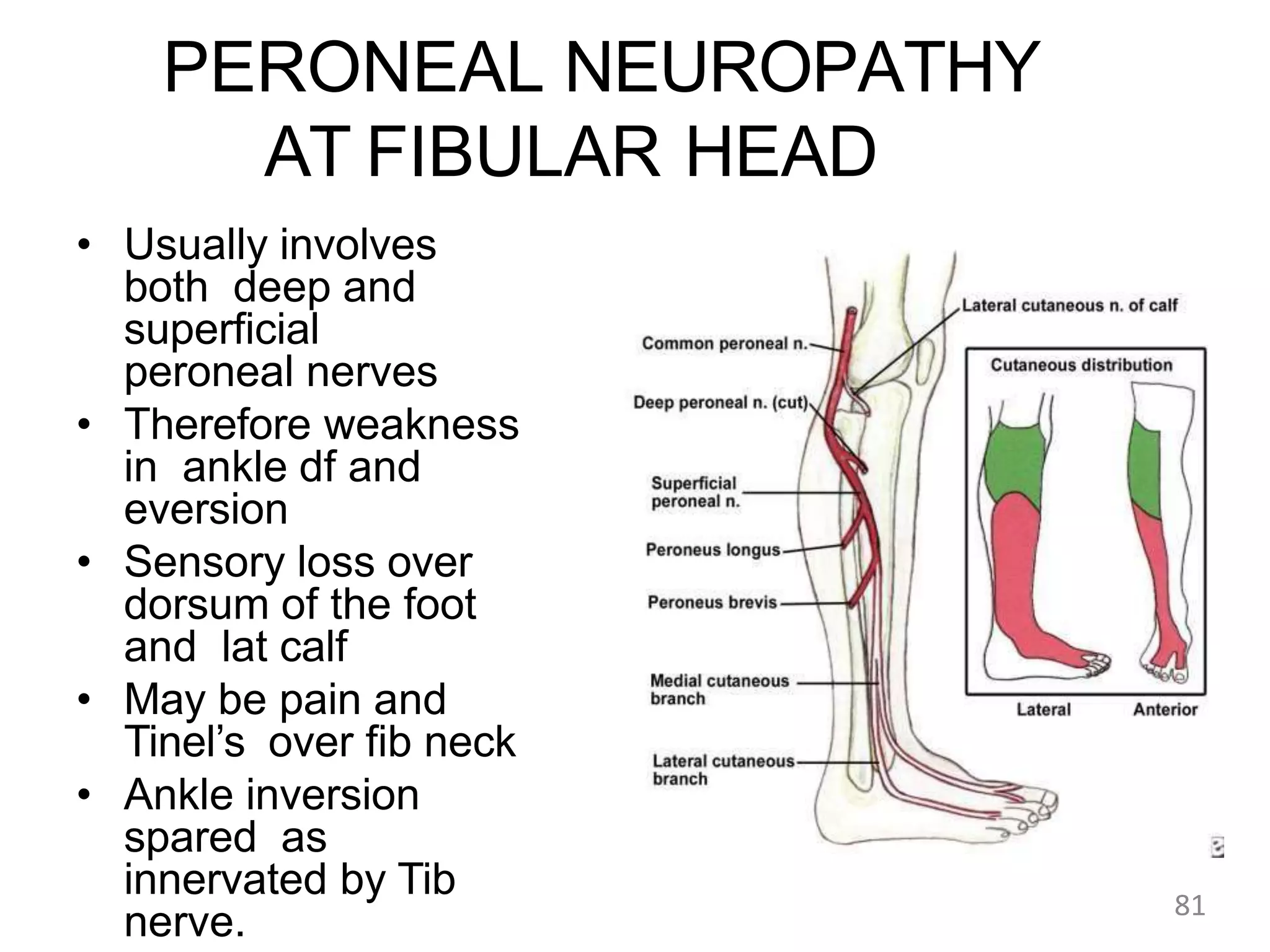 PERONEAL NEUROPATHY
AT FIBULAR HEAD
• Usually involves
both deep and
superficial
peroneal nerves
• Therefore weakness
in ankle df and
eversion
• Sensory loss over
dorsum of the foot
and lat calf
• May be pain and
Tinel’s over fib neck
• Ankle inversion
spared as
innervated by Tib
nerve. 81
 