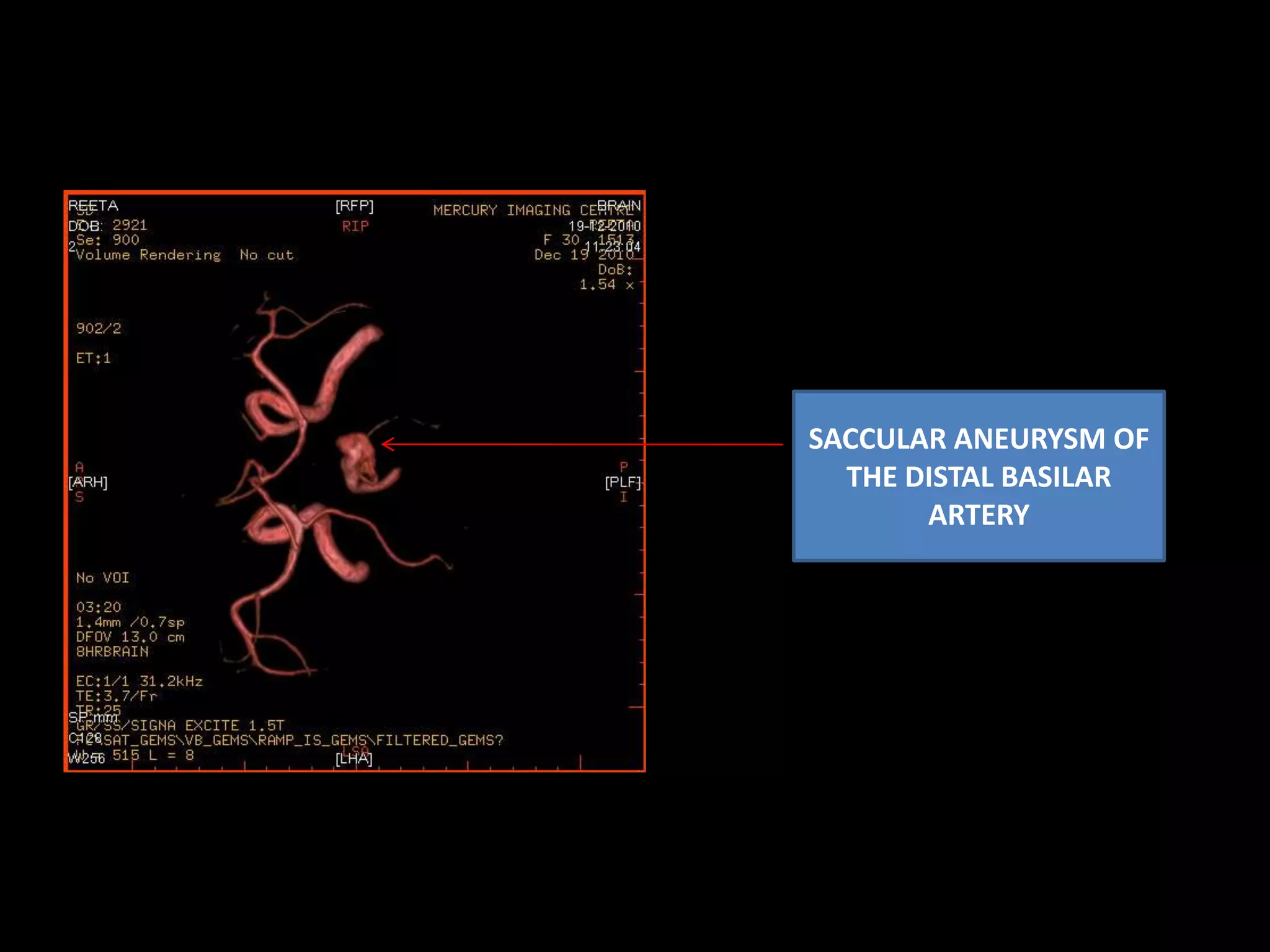 Saccular aneurysm of basilar artery | PPTX | Brain and Nervous System ...