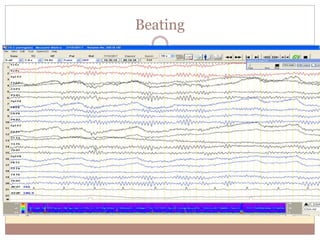 Beating
 