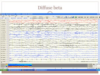 Diffuse beta
 