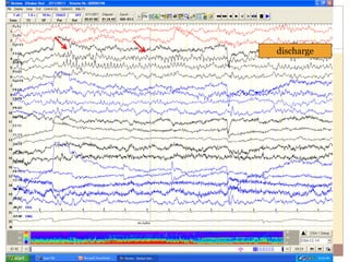 discharge
 