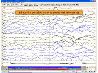 Like Alpha, post slow waves attenuate with eye opening
 