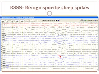 BSSS- Benign spordic sleep spikes
 