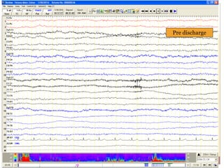 Pre discharge
 