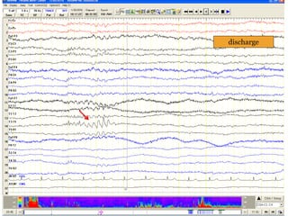 discharge
 