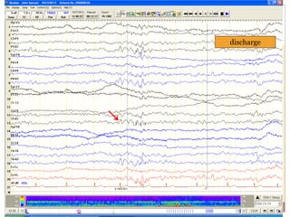 discharge
 